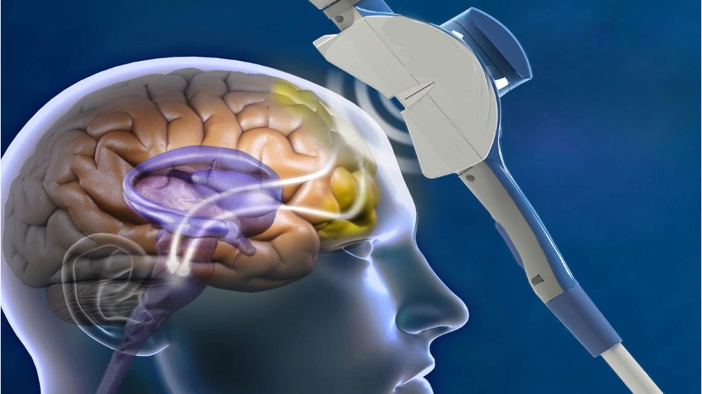 séance de stimulation magnétique transcrânienne