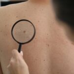 La règle ABCDE pour surveiller ses grains de beauté : comment l’appliquer concrètement ?
