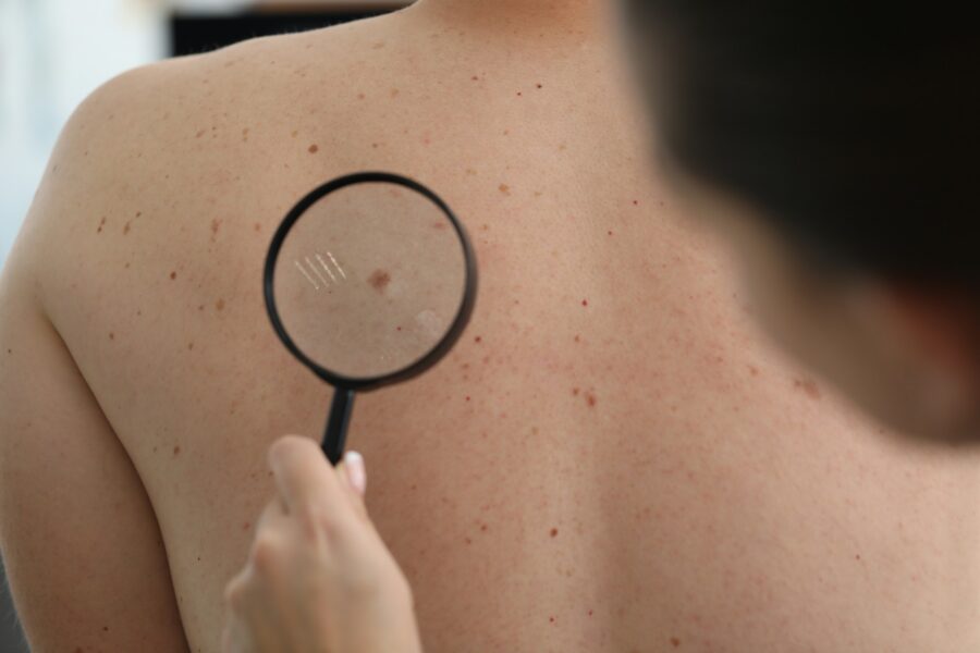 La règle ABCDE pour surveiller ses grains de beauté : comment l’appliquer concrètement ?